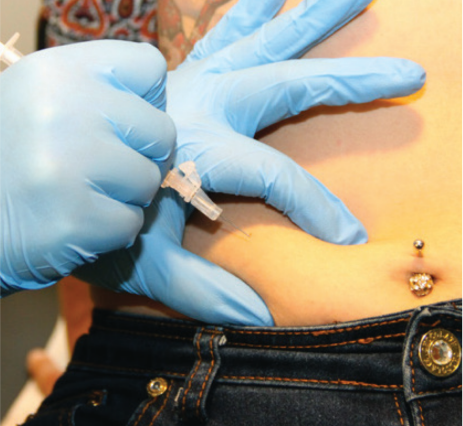 Completing the subcutaneous injection